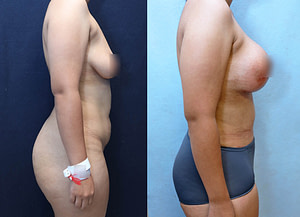 Breast Augmentation Lift Before & After Photos