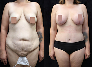 Breast Augmentation Lift Before & After Photos