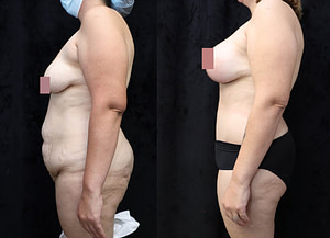 Breast Augmentation Lift Before & After Photos