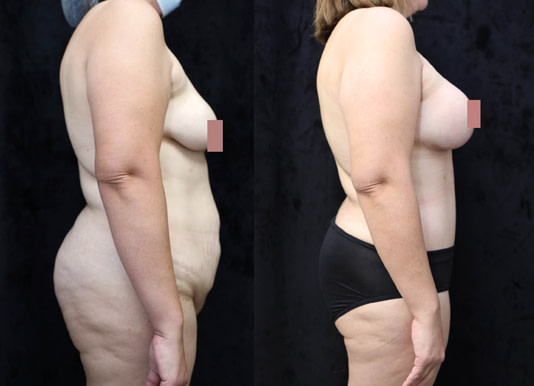Breast Augmentation Lift Before & After Photos