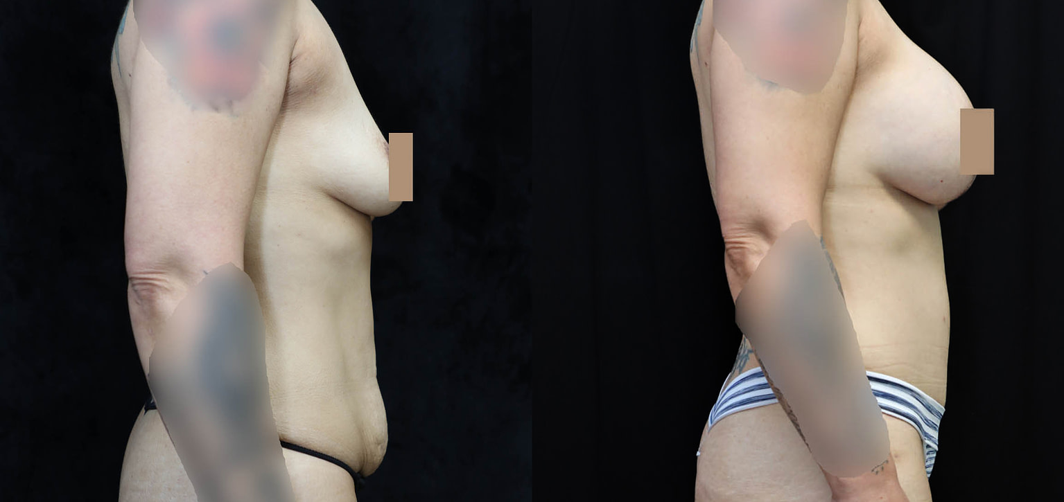 Breast Augmentation Lift Before & After Photos