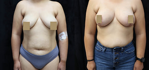 Breast Augmentation Lift Before & After Photos
