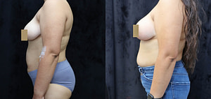 Breast Augmentation Lift Before & After Photos