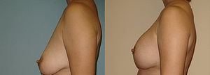 Breast Augmentation With Lift Before & After Photos