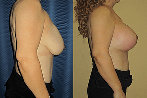 Breast Augmentation With Lift Before & After Photos