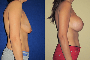 Breast Augmentation With Lift Before & After Photos