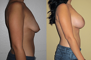 Breast Augmentation With Lift Before & After Photos