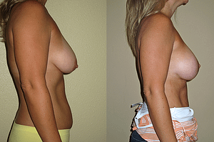 Breast Augmentation With Lift Before & After Photos