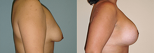 Breast Augmentation With Lift Before & After Photos