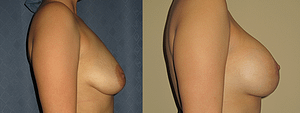 Breast Augmentation With Lift Before & After Photos Right