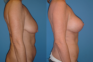 Breast Augmentation With Lift Before & After Photos Right