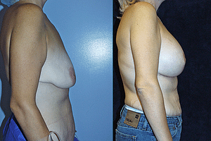 Breast Augmentation With Lift Before & After Photos Right