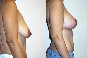 Breast Augmentation With Lift Before & After Photos Right