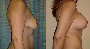 Breast Augmentation With Lift Before & After Photos