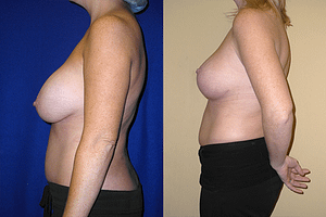 Breast Augmentation With Lift Before & After Photos