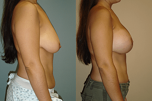 Breast Augmentation With Lift Before & After Photos