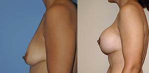 Breast Augmentation With Lift Before & After Photos
