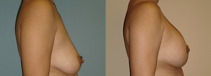 Breast Augmentation With Lift Before & After Photos