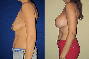 Breast Augmentation With Lift Before & After Photos