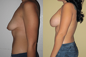 Breast Augmentation With Lift Before & After Photos