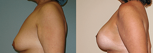 Breast Augmentation With Lift Before & After Photos