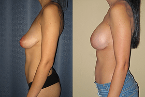 Breast Augmentation With Lift Before & After Photos