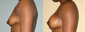 Breast Augmentation With Lift Before & After Photos