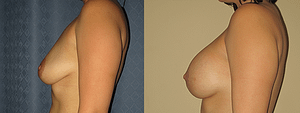Breast Augmentation With Lift Before & After Photos