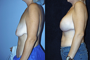Breast Augmentation With Lift Before & After Photos Left