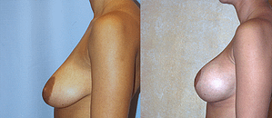 Breast Augmentation With Lift Before & After Photos Left