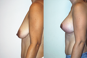 Breast Augmentation With Lift Before & After Photos Left