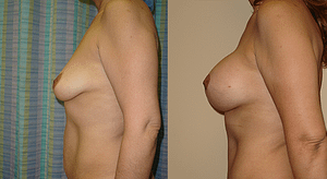 Breast Augmentation With Lift Before & After Photos