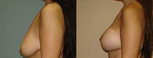 Breast Augmentation With Lift Before & After Photos