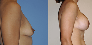 Breast Augmentation With Lift Before & After Photos