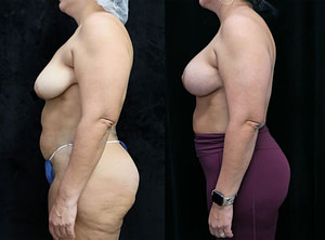 breast lift and augmentation front before and after photo