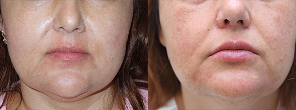Lip Augmentation Before & After Photos