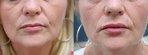 Lip Augmentation Before & After Photos
