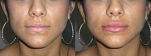 Lip Augmentation Before & After Photos