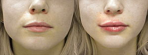 Lip Augmentation Before & After Photos