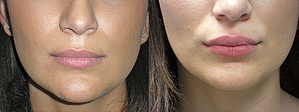 Lip Augmentation Before & After Photos