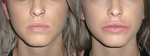 Lip Augmentation Before & After Photos