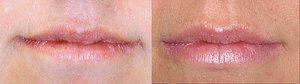Lip Augmentation Before & After Photos