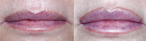 Lip Augmentation before and after Photos