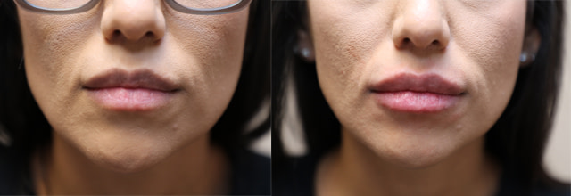 patient before and after lip fillers