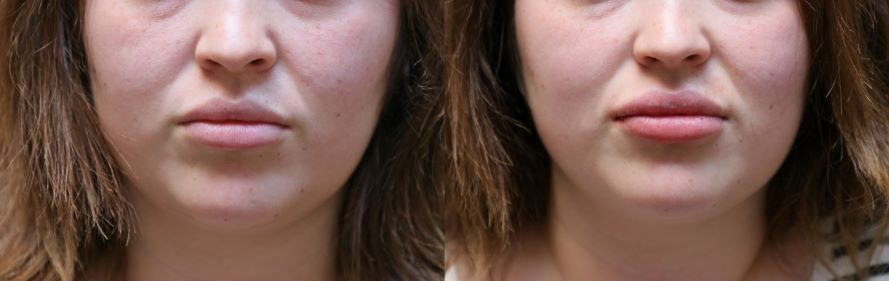 lip augmentation before and after