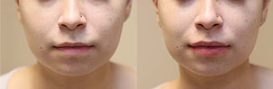 lip augmentation before and after photos