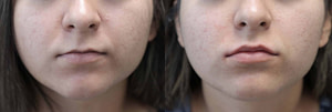 lip augmentation before and after photo