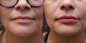 Lip Augmentation Before & After Photos