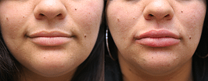 Lip Augmentation Before & After Photos