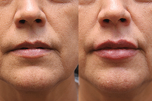 lipfiller Before & After Photos